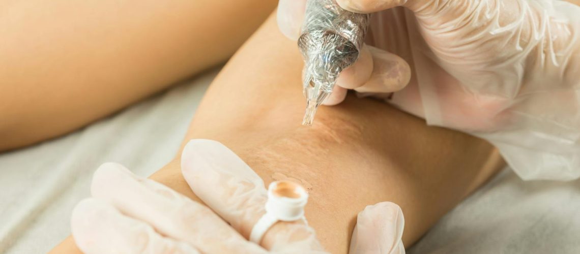 Tatouer ses vergetures pour les masquer : bonne ou mauvaise idée ?